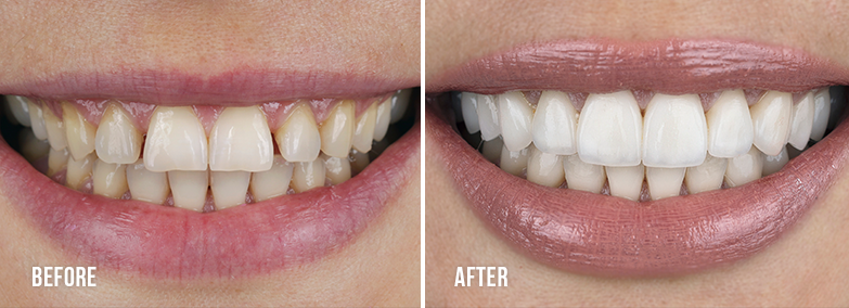 Teeth Whitening 1 - Thousand Smiles