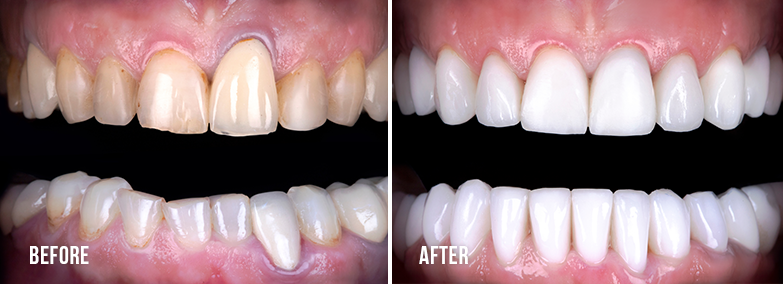 Teeth Whitening 2 - Thousand Smiles