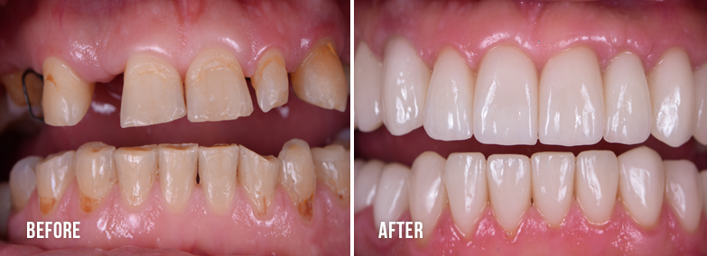 Teeth Whitening 3 - Thousand Smiles