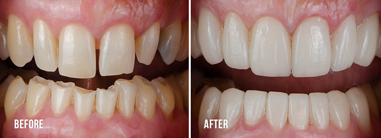 Teeth Whitening 4 - Thousand Smiles