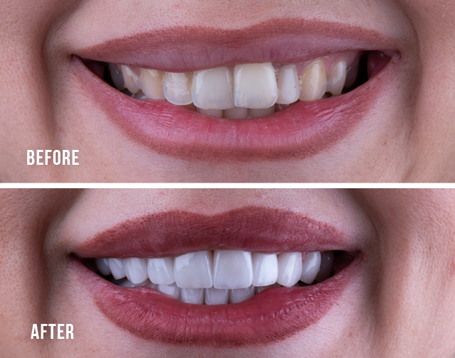 before after e max veneers