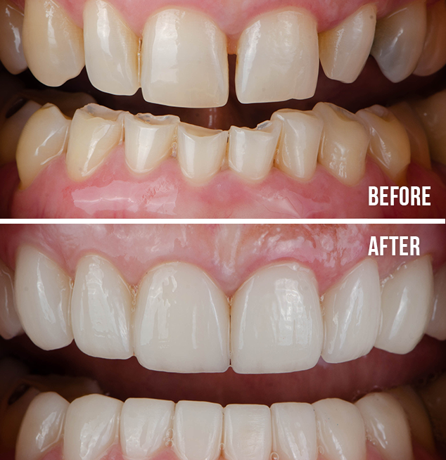 composite bonding before after