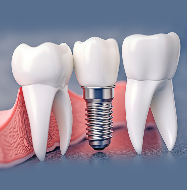 dental implants clinic london