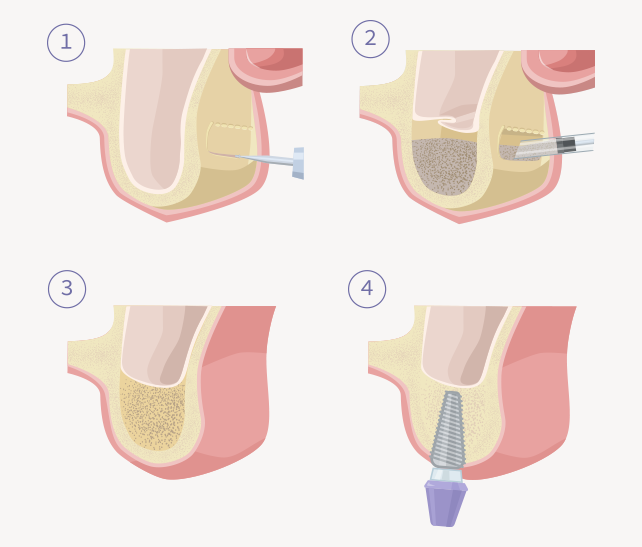 dental implants tooth implantation