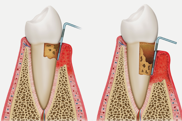 Periodontics London Periodontal Treatment London