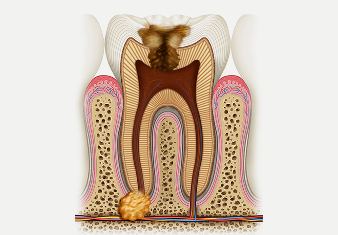How-long-is-root-canal-recovery? - Thousand Smiles