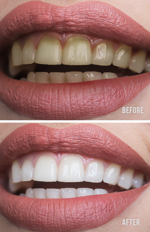 teeth whitening before after