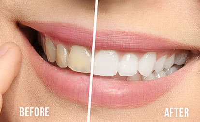zoom teeth whitening before after