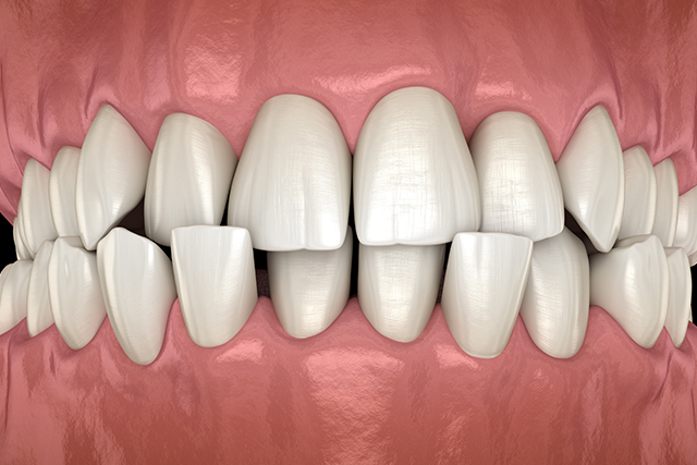 Skeletal crossbite Dental Condition