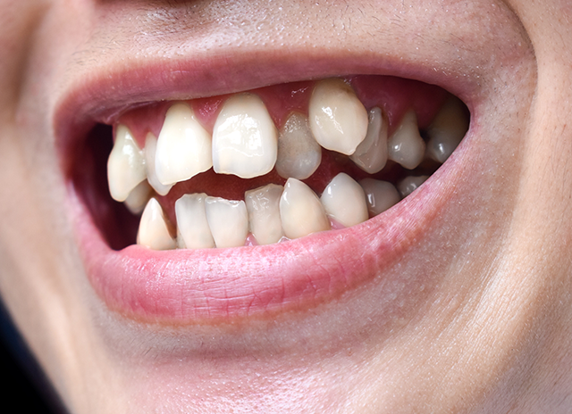 Best Crowded Teeth Treatment Condition