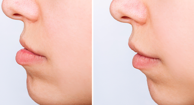 Everything you Should Know About Teeth Overbite Or Overjet