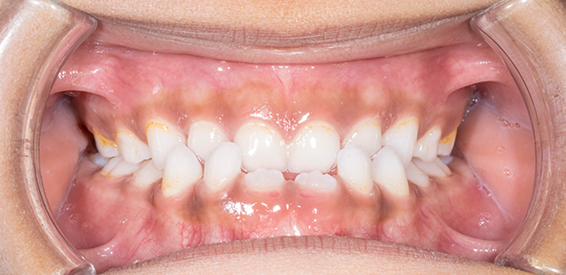 Types of Crossbite Dental Condition