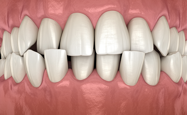 Crowded Teeth Treatment Cost