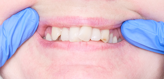 Open Bite Teeth Treatment