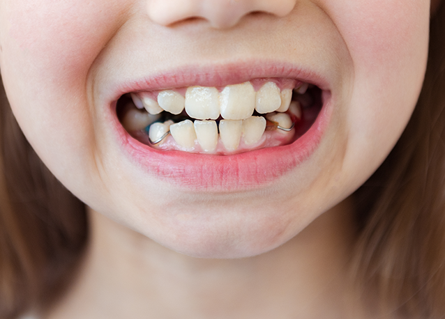 Open Bite Treatment Cost London