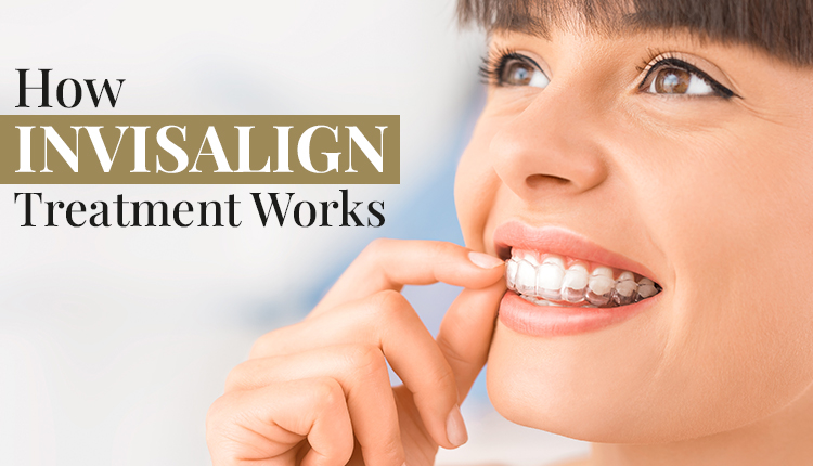 How Invisalign Treatment Works