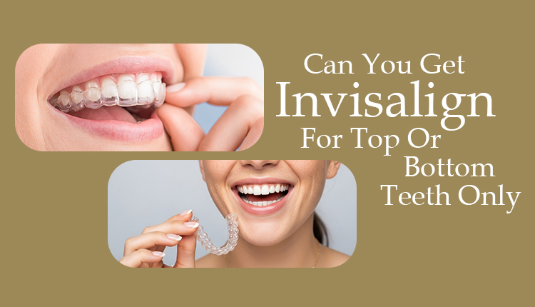 Can You Get Invisalign For Top Or Bottom Teeth Only