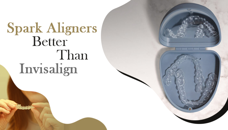 Spark Aligners Better Than Invisalign